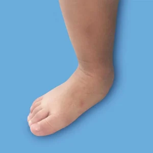 6082e5de31795984b924e9fe_pieplano-diegoortizortopediainfantil